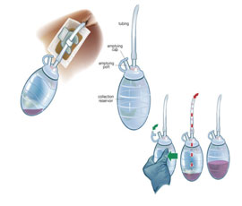 subcutaneous tissue post mastectomy wound care page Dr. Miltenburg